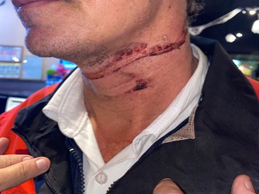 Motociclista sofre ferimento no pescoço por cabo solto 