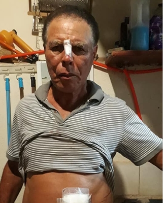 IDOSO LEVA 10 PONTOS NO NARIZ E BARRIGA APOS ATAQUE DE PITBULL