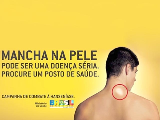 VOTUPORANGA REGISTRA 10 CASOS DE HANSENÍASE EM 2017